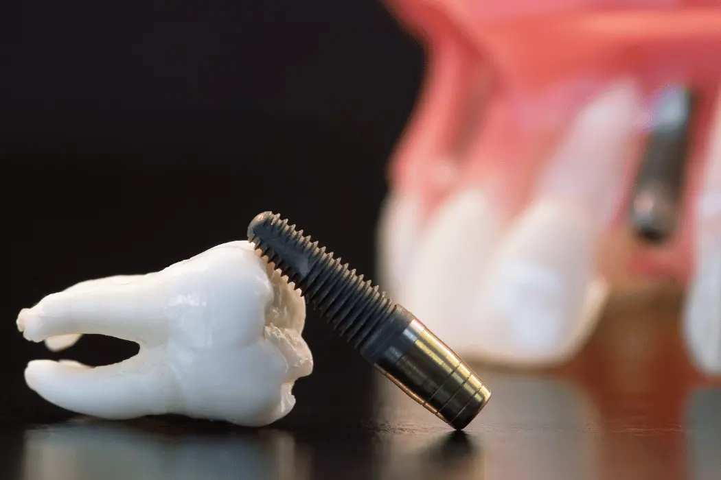 The Enduring Benefits of Dental Implants The Enduring Benefits of Dental Implants