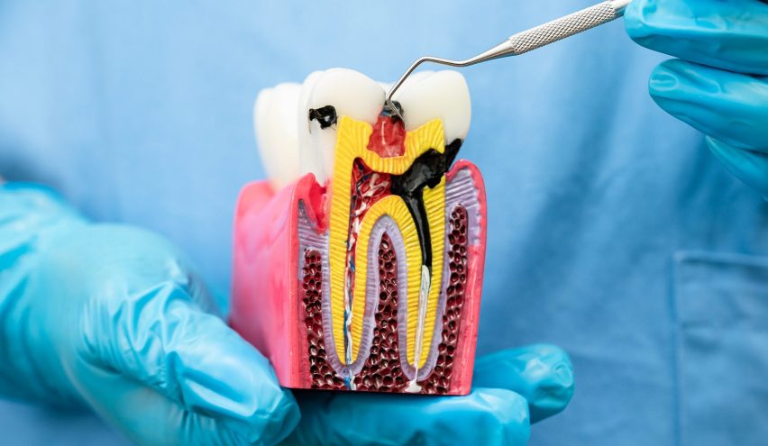 Root-Canal-Treatment-e1741468266918