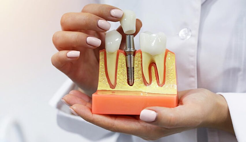 dental implants